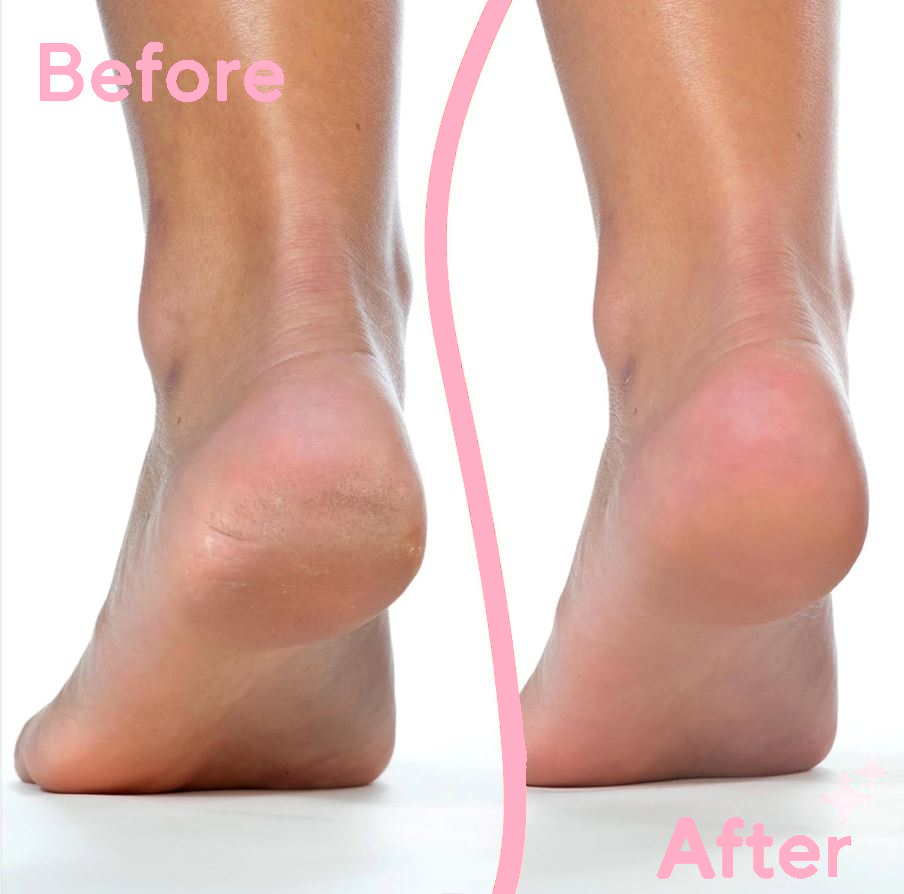 Ultimate Foot Care Set: Callus Remover & Manicure Magic